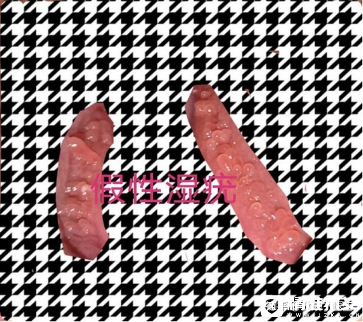 尖锐湿疣