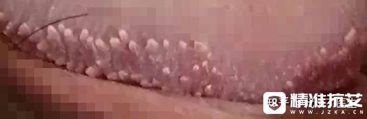 尖锐湿疣